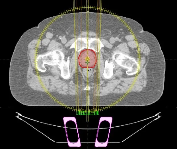 Understanding IMRT, VMAT, and SBRT Treatment Planning
